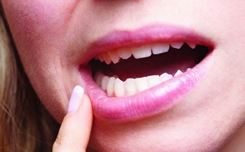 Стоматит у взрослых