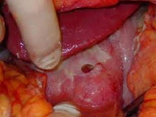 Прободная язва фото