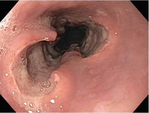 Дистальный эзофагит