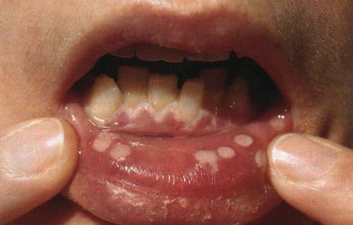 Герпетический стоматит