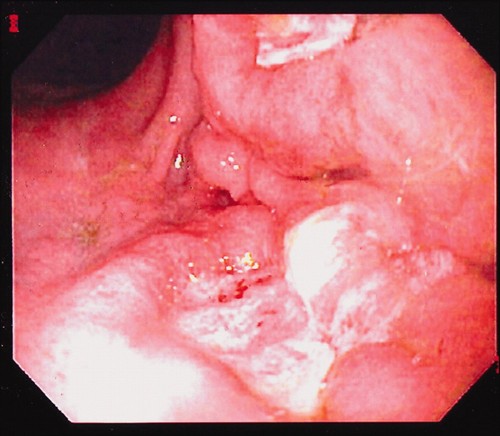 Поверхностный дуоденит