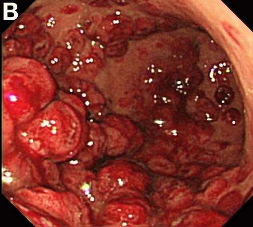 Острая язва желудка