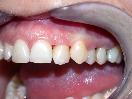 Стоматит на десне