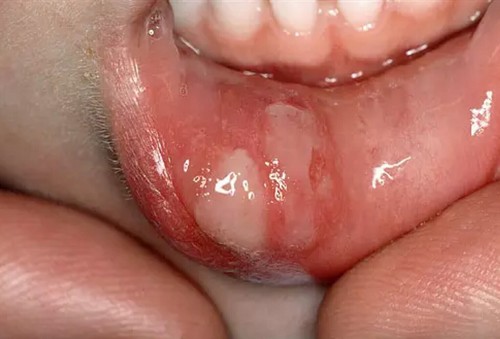 Стоматит на губе