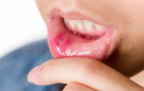 Язвенный стоматит