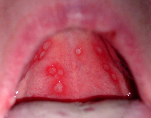 Стоматит у детей