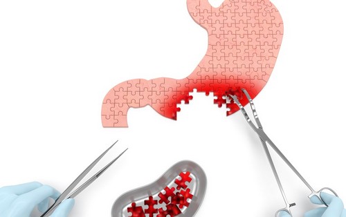 Рак желудка