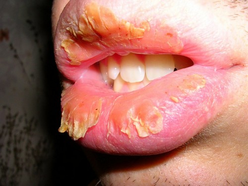 Как выглядит ангулярный стоматит