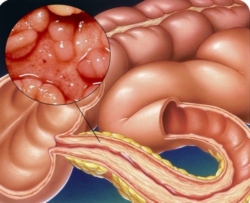 Катаральный проктит