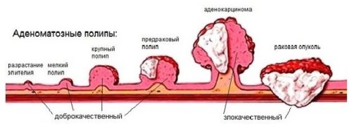 Разновидности полипов