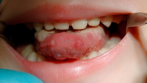 Грибковый стоматит у детей
