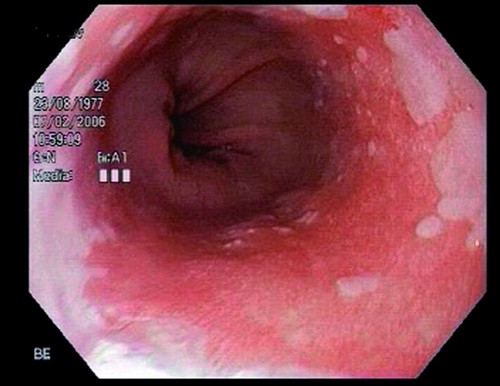 Как выглядит пищевод Барретта