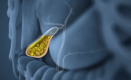 Перегиб желчного пузыря