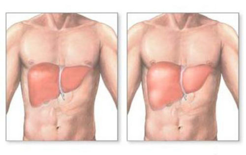 Увеличение печени – причины, диагностика, правильная терапия