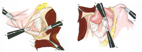Фундопликация