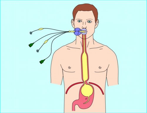 Зонд блэкмора