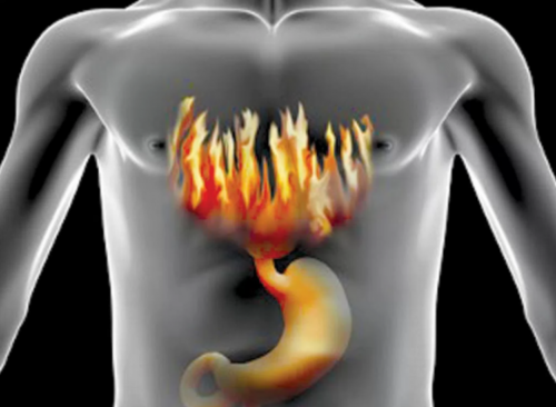 Изжога и жжение в пищеводе