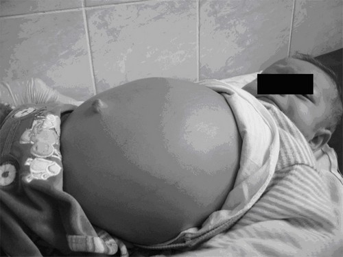 Гепатомегалия - это процесс повышения объемов печени