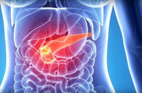 Панкреатит у женщин