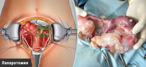 Лапаротомный разрез