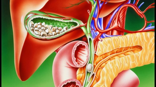Камни поджелудочной железы – опасность заболевания