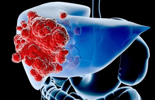 Всё о гемангиоме печени