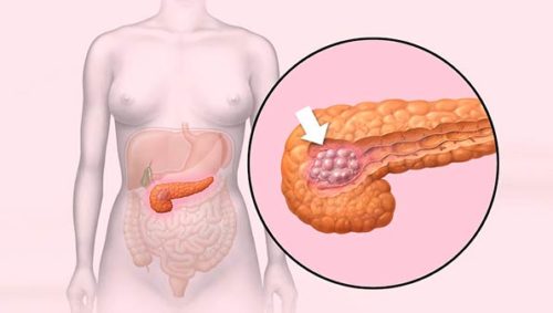 Характеристика и методика лечения некроза поджелудочной железы