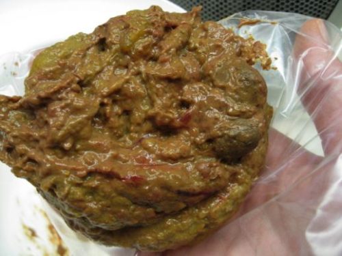 Кал при панкреатите у взрослых