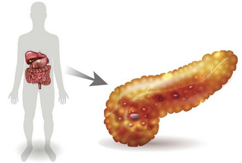 Отечный панкреатит – причины развития, симптомы, правильное лечение